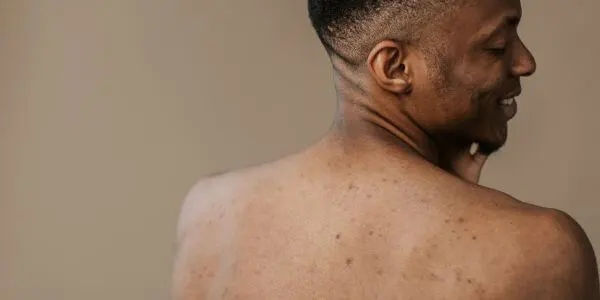 Man en hormonale acne