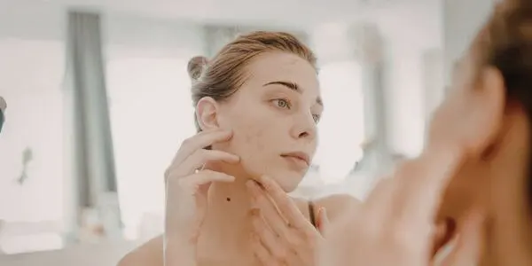 Vrouw en hormonale acne